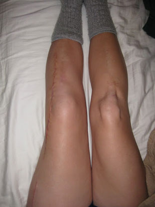 Rot-Def-Post-Op